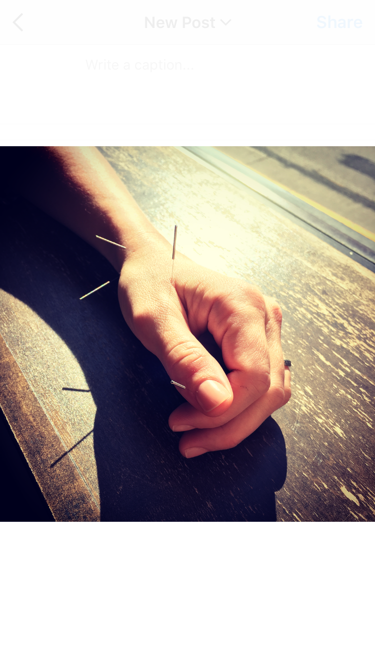 Arthritis & Acupuncture